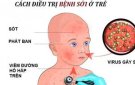 Tăng cường công tác phòng chống bệnh Sởi
